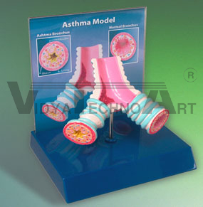 Asthma Model